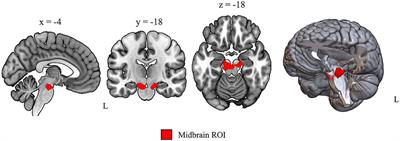 Random forest analysis of midbrain hypometabolism using [18F]-FDG PET identifies Parkinson's disease at the subject-level